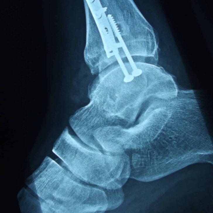 X ray of ankle injury