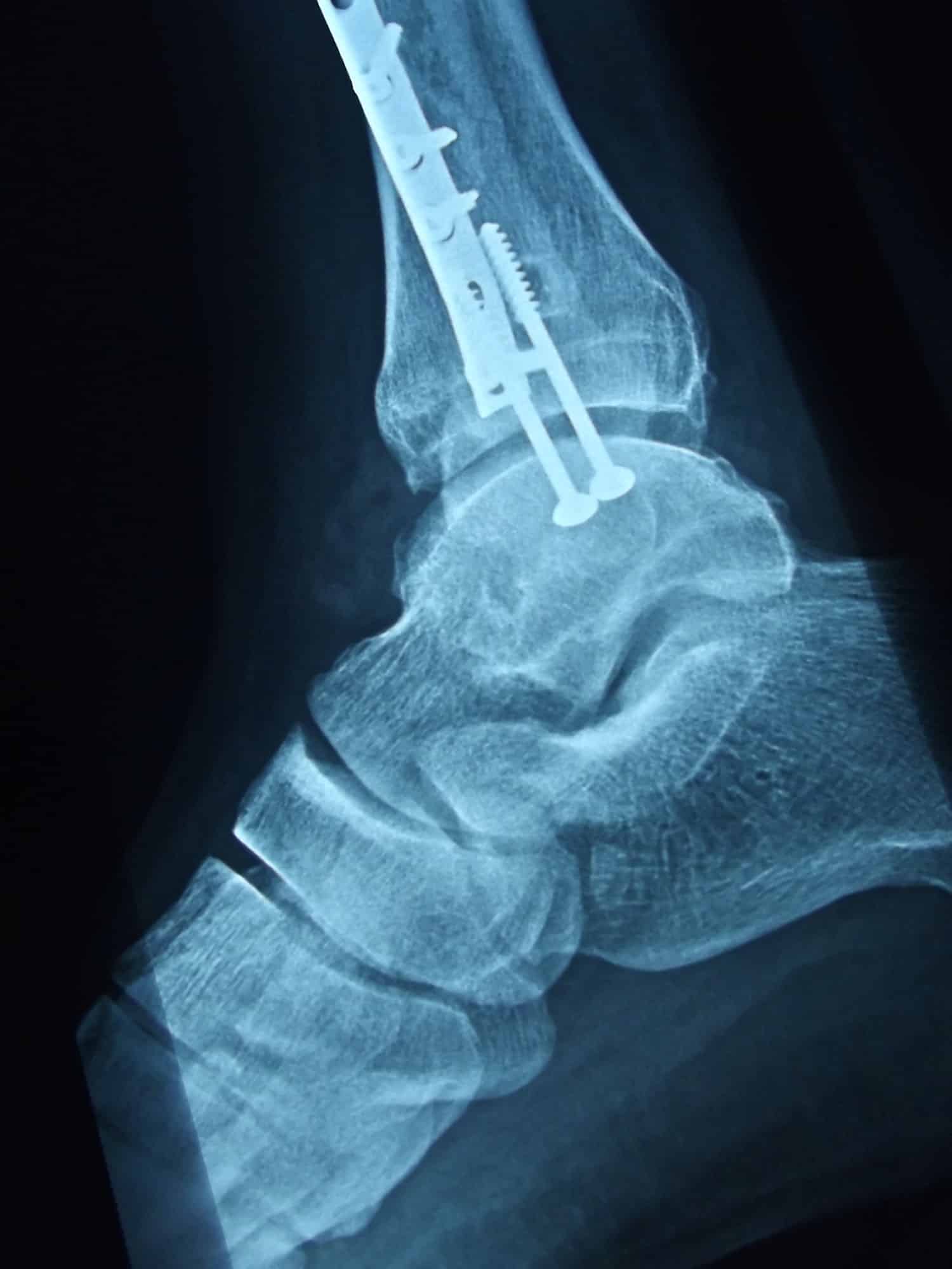 X ray of ankle injury