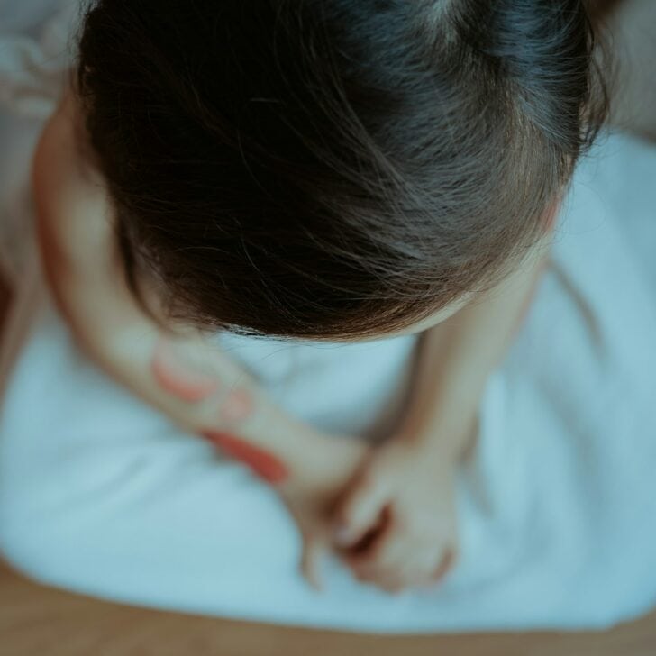 Sad and Frightened Little Girl with Bloodshot and Bruised spots on the body. Child abuse among child