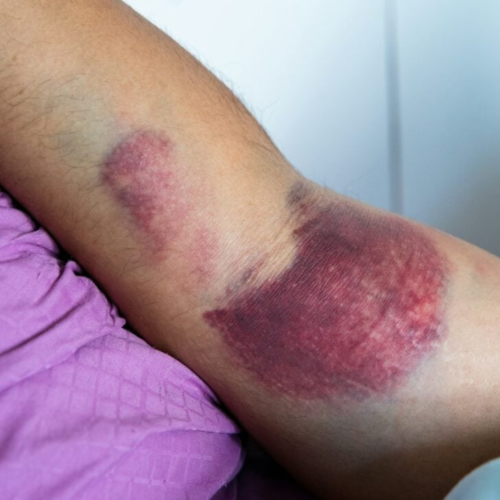 Bicep tear or strain, tendon injuries on a muscular man hand. Trauman or trauma injury.