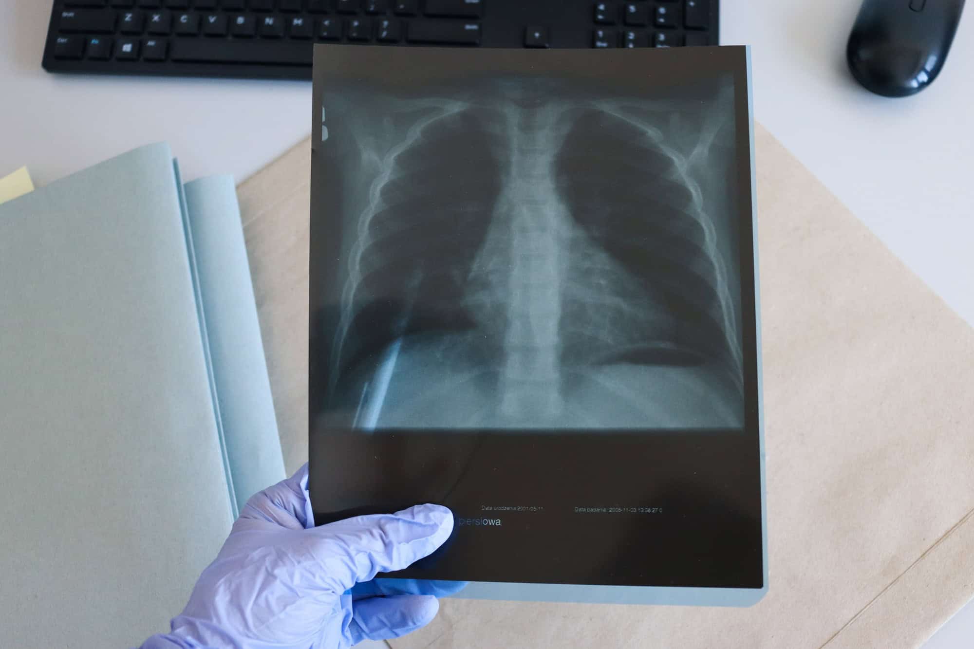 X-ray of the chest.